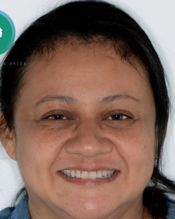 Cierre de diastema y alineación — después del tratamiento