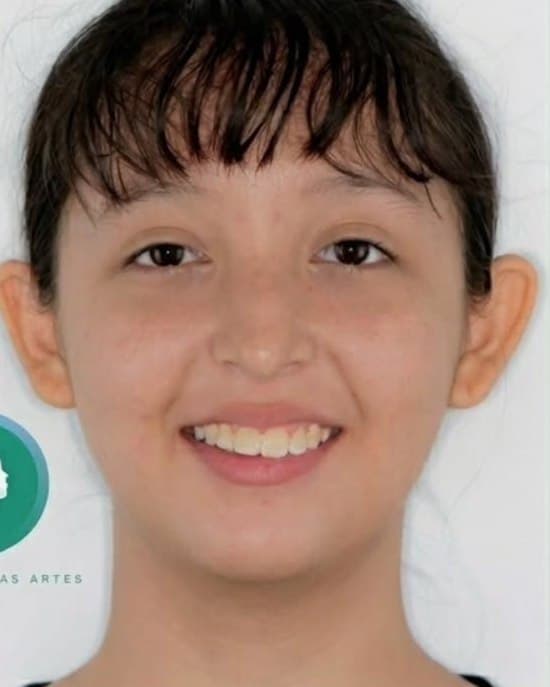 Renovación total de sonrisa — después del tratamiento