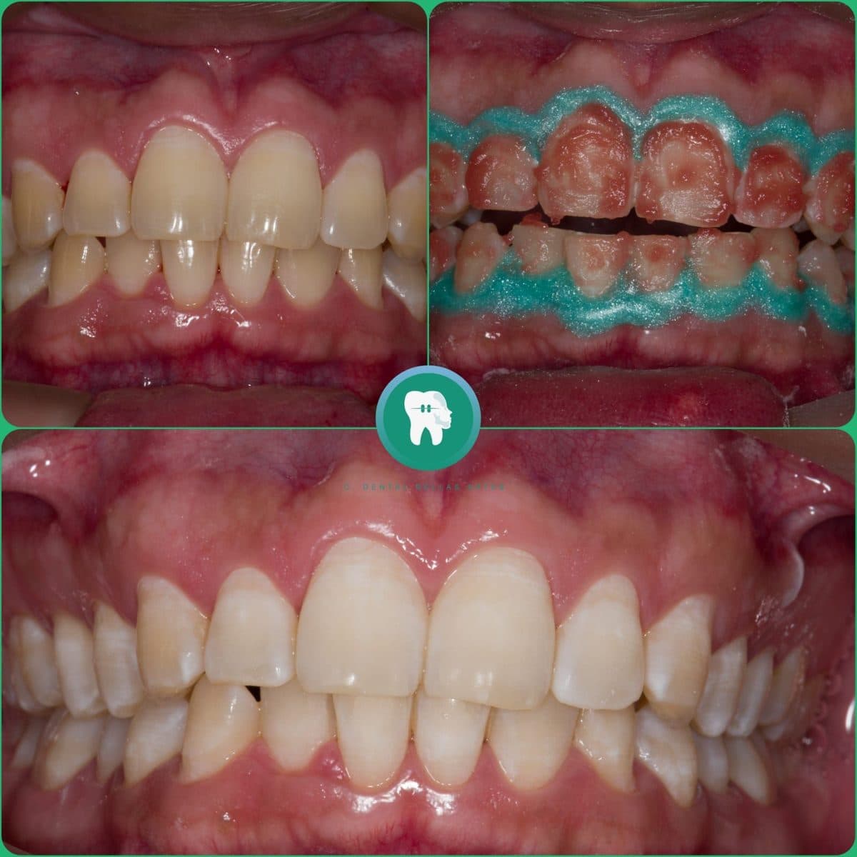 Blanqueamiento dental hecho en Clínica Dental Bellas Artes: los dientes antes, durante la aplicación y después