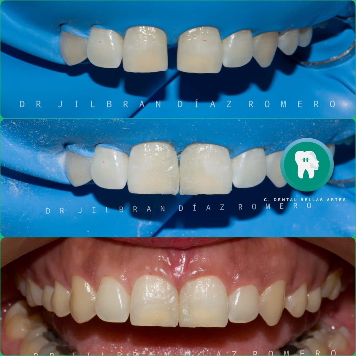 Cierre de un espacio entre los dientes centrales con resina, antes y después