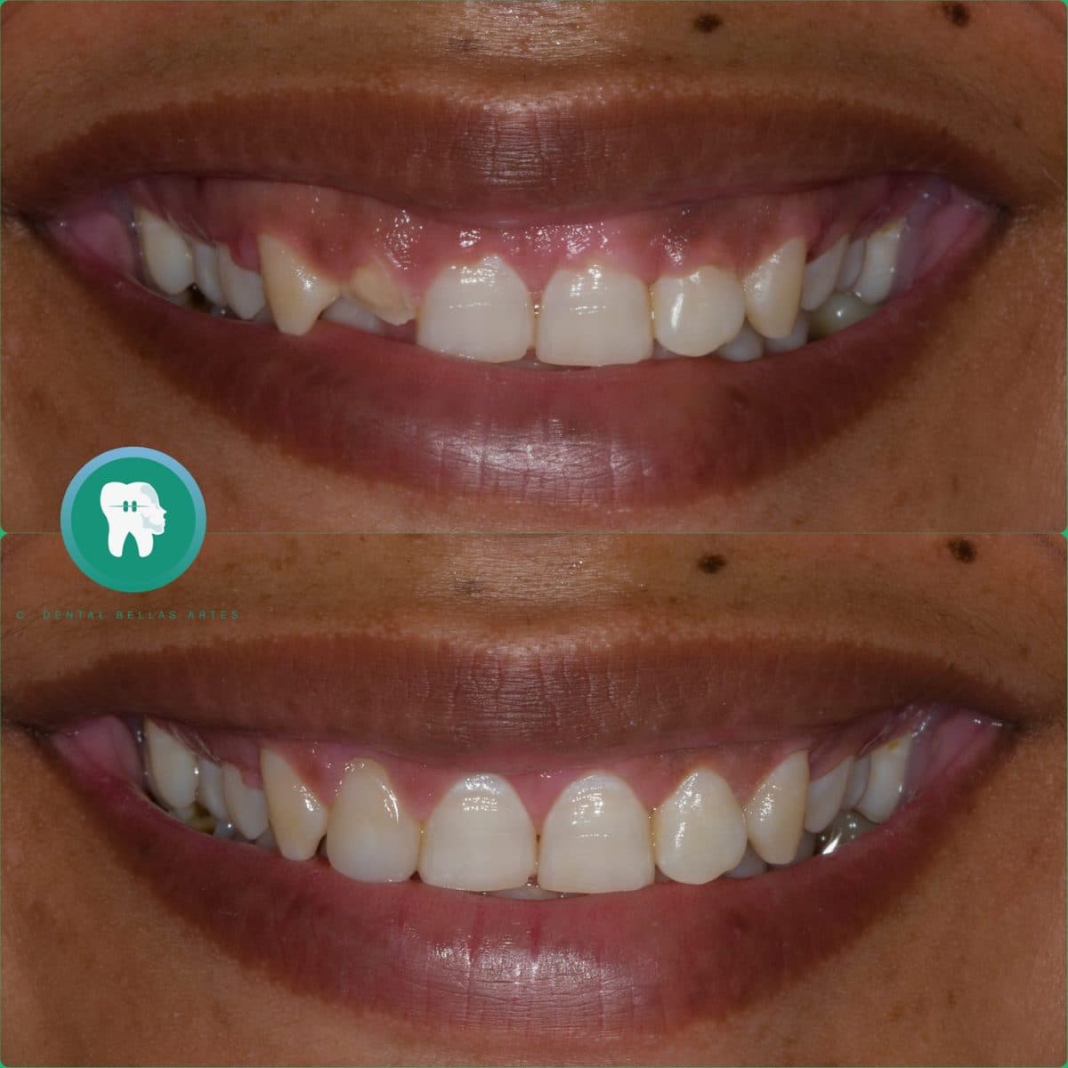 Antes y después de reconstruir con resina los bordes de los dientes de adelante