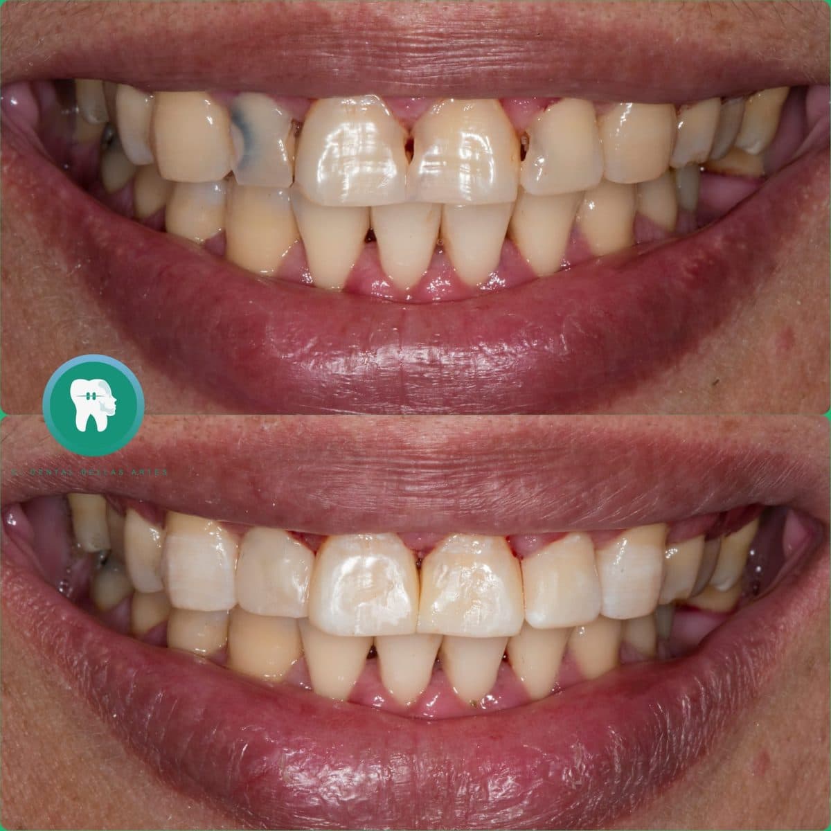 Dientes de adelante desgastados y reconstruidos con resina en Clínica Dental Bellas Artes, antes y después