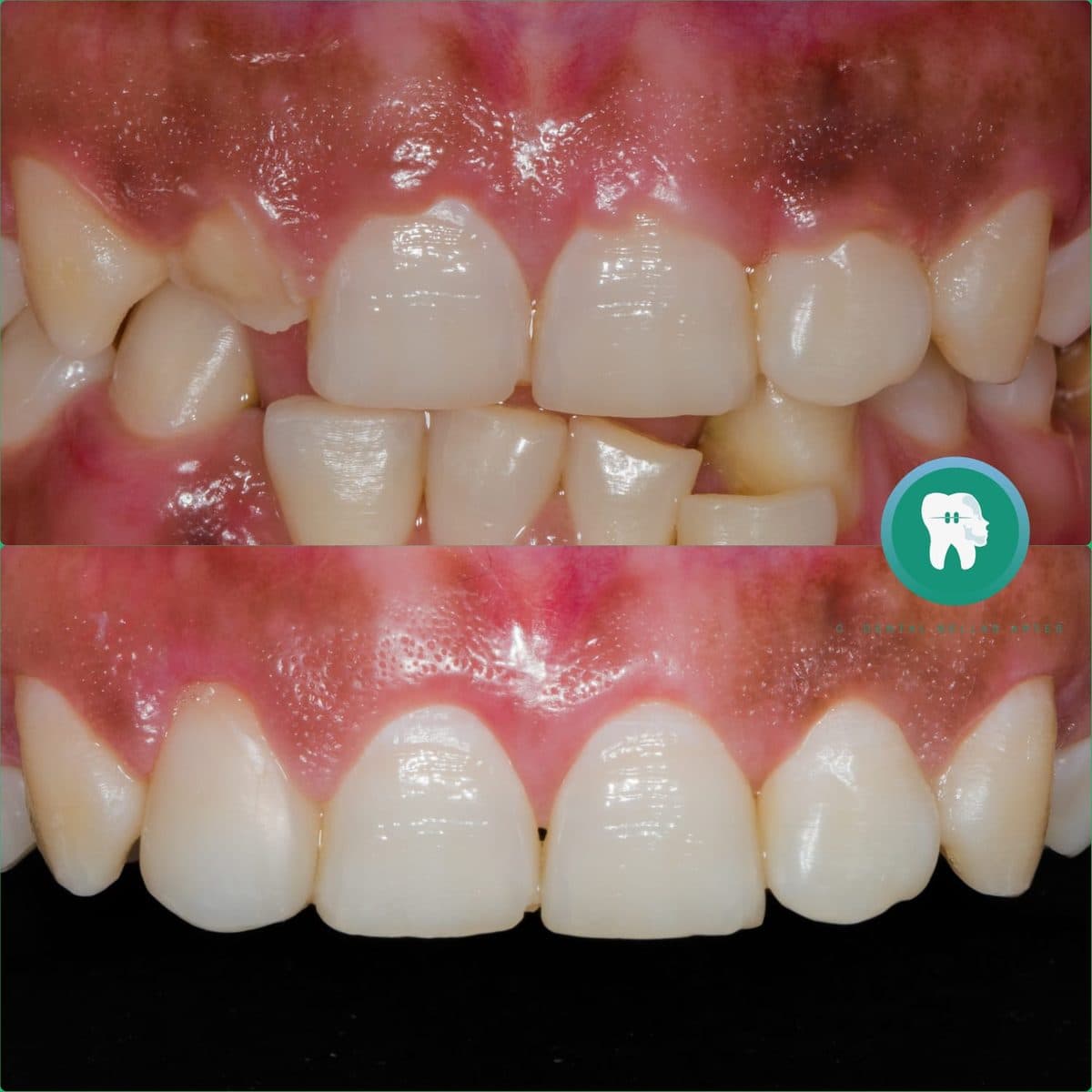 Antes y después de reconstruir con resina dos dientes centrales fracturados
